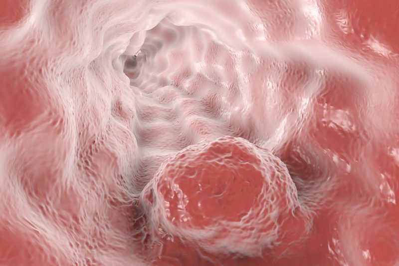 Esophageal cancer, 3D illustration showing tumor on the wall of esophagus.