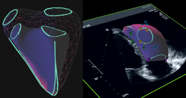 Heart scans using Ventripoint Diagnostic's VMS+ technology