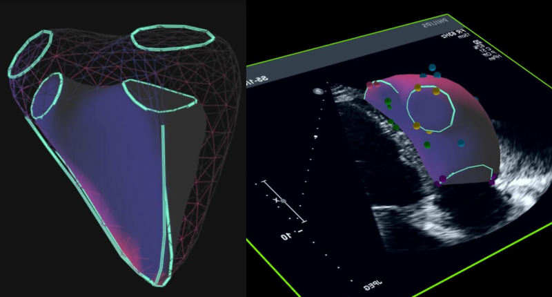 Heart scans using Ventripoint Diagnostic's VMS+ technology